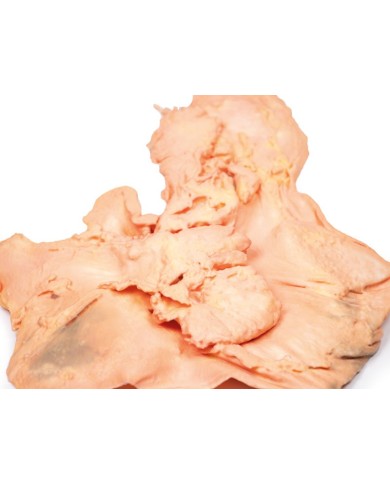 Adenocarcinoma dello stomaco Erler Zimmer 3D anatomy Series MP2080