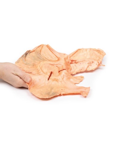 Adenocarcinoma dello stomaco Erler Zimmer 3D anatomy Series MP2080