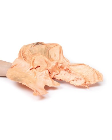 Adenocarcinoma dello stomaco Erler Zimmer 3D anatomy Series MP2080