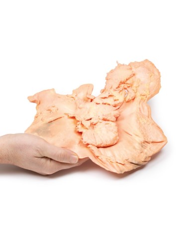 Adenocarcinoma dello stomaco Erler Zimmer 3D anatomy Series MP2080