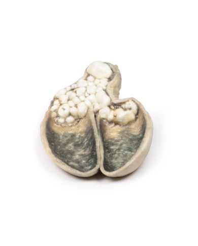 Colecistite e colelitiasi Erler Zimmer 3D anatomy Series MP2082