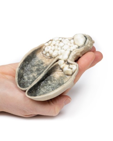 Colecistite e colelitiasi Erler Zimmer 3D anatomy Series MP2082