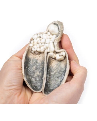 Colecistite e colelitiasi Erler Zimmer 3D anatomy Series MP2082