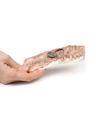 Adenoma peduncolato del colon Erler Zimmer 3D anatomy Series MP2081