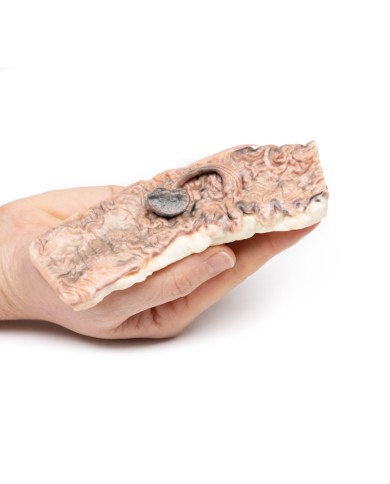 Adenoma peduncolato del colon Erler Zimmer 3D anatomy Series MP2081