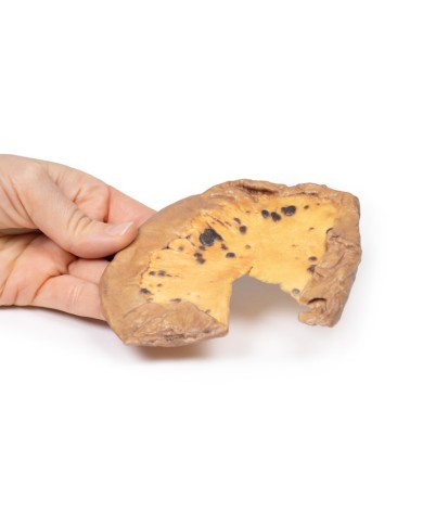 Metastasi mesenteriche da melanoma cutaneo maligno Erler Zimmer 3D anatom