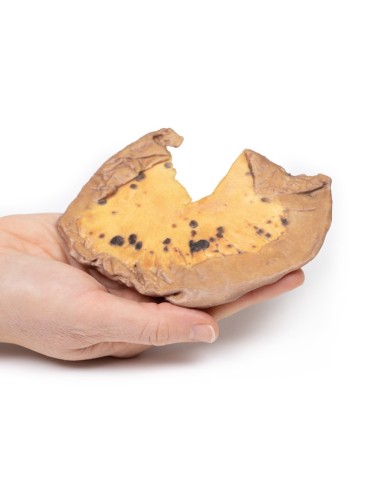 Metastasi mesenteriche da melanoma cutaneo maligno Erler Zimmer 3D anatom