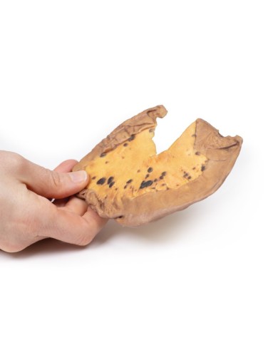 Metastasi mesenteriche da melanoma cutaneo maligno Erler Zimmer 3D anatom