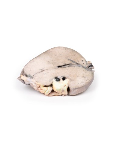 Calcoli del dotto epatico e cirrosi biliare ostruttiva Erler Zimmer 3D an