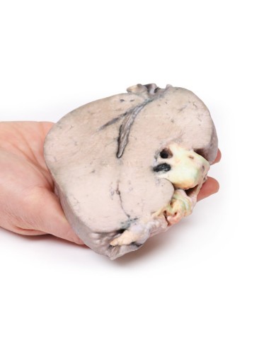 Calcoli del dotto epatico e cirrosi biliare ostruttiva Erler Zimmer 3D an