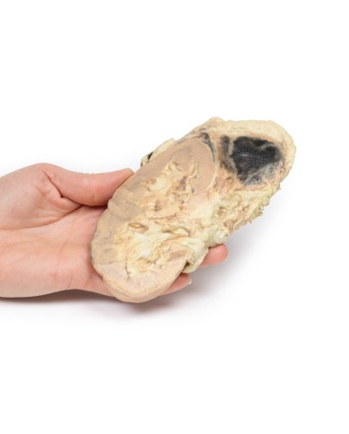 Emorragia surrenale sindrome di Waterhouse Friderichsen Erler Zimmer 3D a