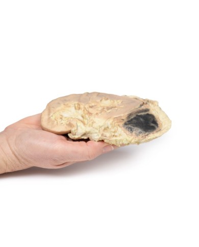 Emorragia surrenale sindrome di Waterhouse Friderichsen Erler Zimmer 3D a