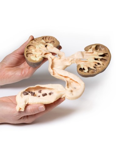 idronefrosi e idrouretere Erler Zimmer 3D anatomy Series MP2093