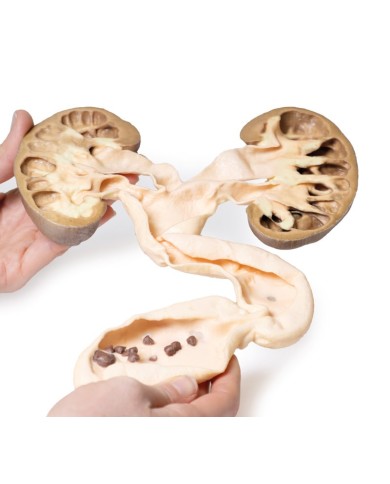 idronefrosi e idrouretere Erler Zimmer 3D anatomy Series MP2093