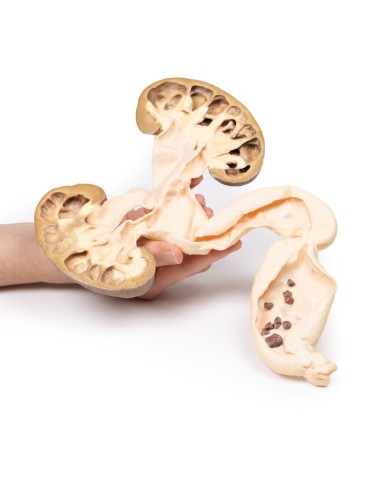 idronefrosi e idrouretere Erler Zimmer 3D anatomy Series MP2093