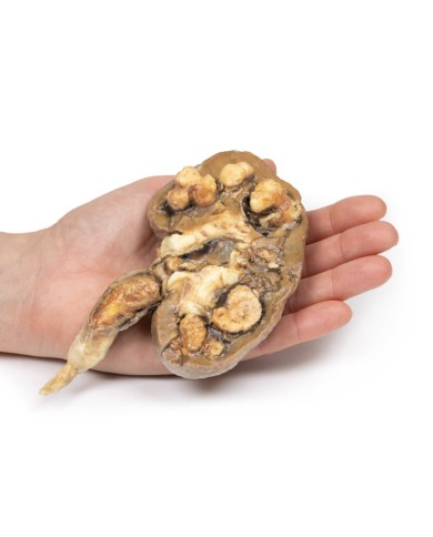 Calcoli renali multipli Erler Zimmer 3D anatomy Series MP2095