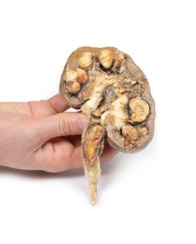 Calcoli renali multipli Erler Zimmer 3D anatomy Series MP2095