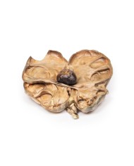 Idronefrosi e idrouretere causati da ostruzione da un calcolo renale Erle