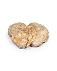 Idronefrosi e idrouretere causati da ostruzione da un calcolo renale Erle