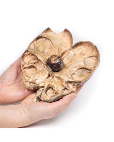 Idronefrosi e idrouretere causati da ostruzione da un calcolo renale Erle