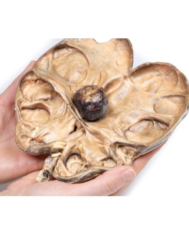 Idronefrosi e idrouretere causati da ostruzione da un calcolo renale Erle