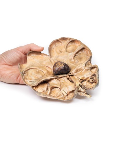 Idronefrosi e idrouretere causati da ostruzione da un calcolo renale Erle