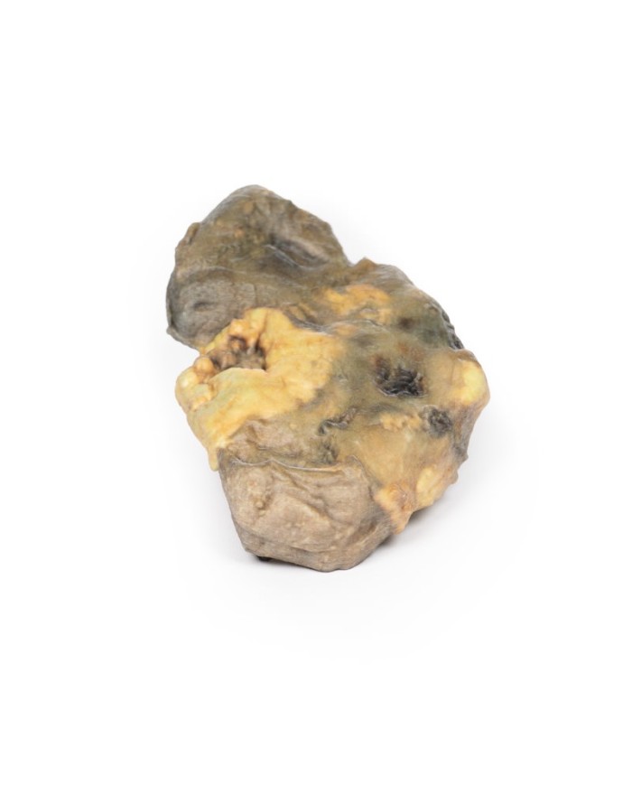 Pionefrosi Erler Zimmer 3D anatomy Series MP2096