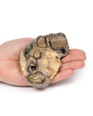 Pionefrosi Erler Zimmer 3D anatomy Series MP2096