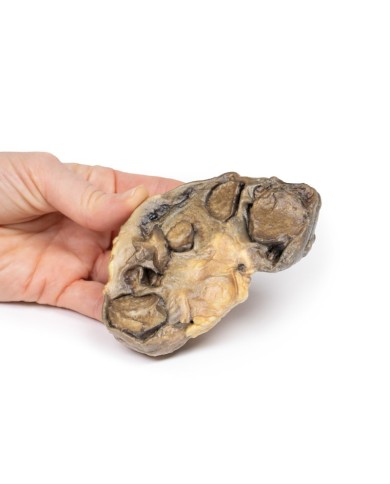 Pionefrosi Erler Zimmer 3D anatomy Series MP2096