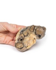 Pionefrosi Erler Zimmer 3D anatomy Series MP2096