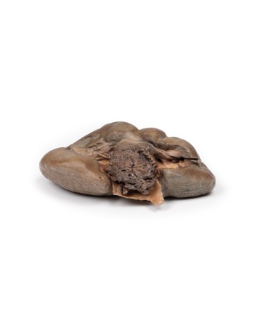 Carcinoma papillare a cellule di transizione della pelvi renale Erler Zim