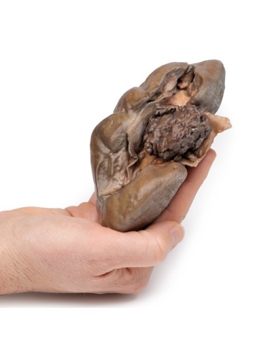 Carcinoma papillare a cellule di transizione della pelvi renale Erler Zim