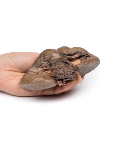 Carcinoma papillare a cellule di transizione della pelvi renale Erler Zim