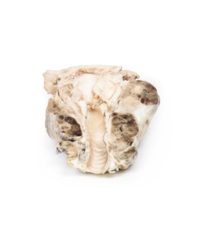 Gozzo multinodulare Erler Zimmer 3D anatomy Series MP2101