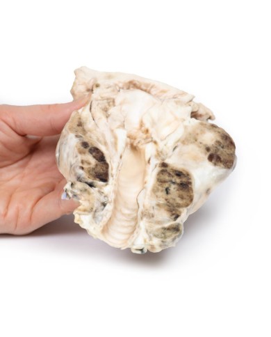 Gozzo multinodulare Erler Zimmer 3D anatomy Series MP2101