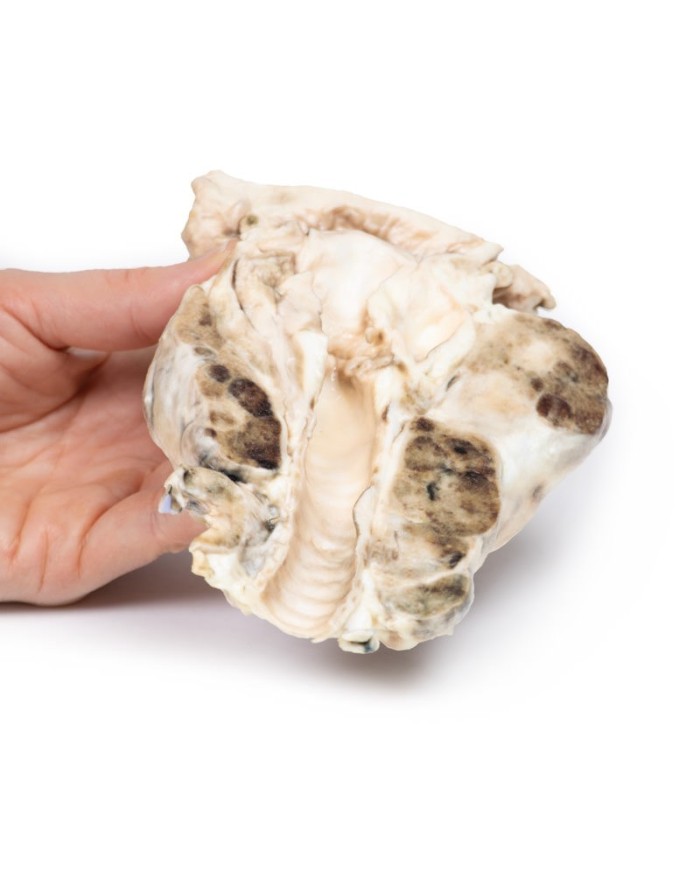 Gozzo multinodulare Erler Zimmer 3D anatomy Series MP2101