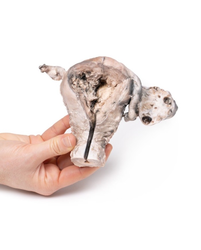 Carcinoma endometriale Erler Zimmer 3D anatomy Series MP2106