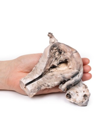 Carcinoma endometriale Erler Zimmer 3D anatomy Series MP2106