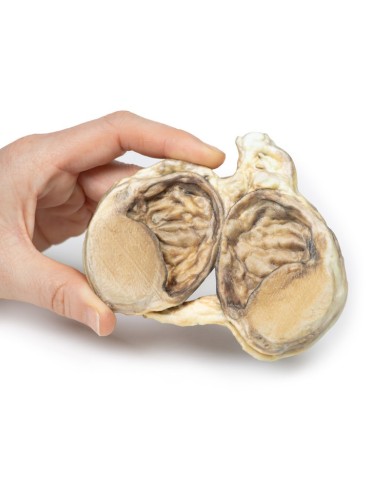 Idrocele cronico Erler Zimmer 3D anatomy Series MP2110