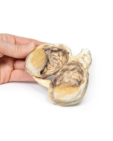 Idrocele cronico Erler Zimmer 3D anatomy Series MP2110