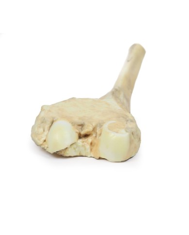 Osteosarcoma del femore Erler Zimmer 3D anatomy Series MP2115