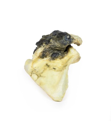 Condrosarcoma della scapola Erler Zimmer 3D anatomy Series MP2114