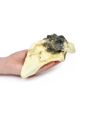 Condrosarcoma della scapola Erler Zimmer 3D anatomy Series MP2114