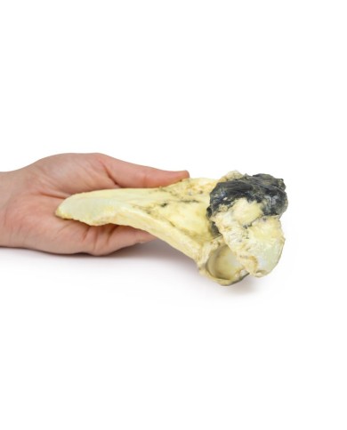 Condrosarcoma della scapola Erler Zimmer 3D anatomy Series MP2114