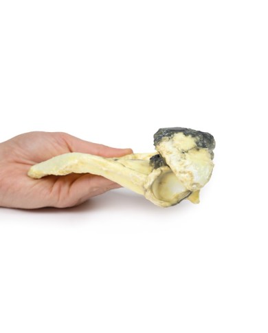 Condrosarcoma della scapola Erler Zimmer 3D anatomy Series MP2114