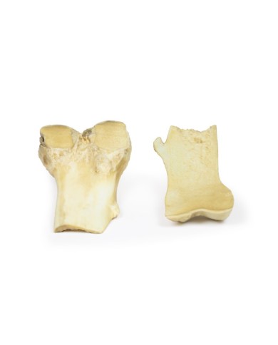 Osteocondroma Erler Zimmer 3D anatomy Series MP2118