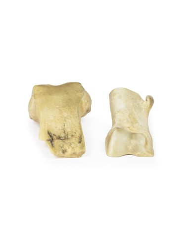 Osteocondroma Erler Zimmer 3D anatomy Series MP2118