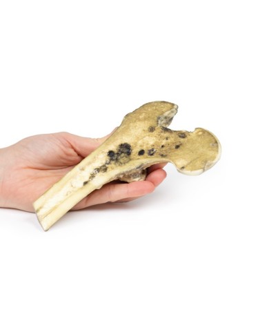 Melanoma maligno metastatico Erler Zimmer 3D anatomy Series MP2117