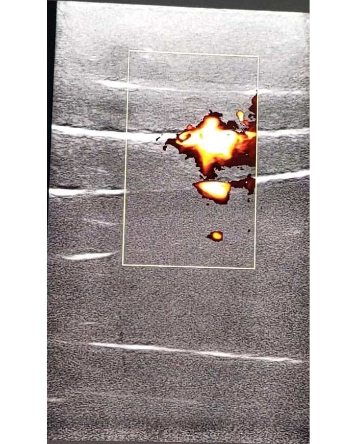 Simulatore per iniezioni sul piano fasciale SonoEZ