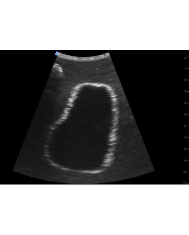 Trainer per ecografica della vescica SonoEZ